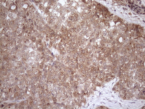 FGF13 Antibody - Immunohistochemical staining of paraffin-embedded Adenocarcinoma of Human endometrium tissue using anti-FGF13 mouse monoclonal antibody. (Heat-induced epitope retrieval by 1mM EDTA in 10mM Tris buffer. (pH8.5) at 120 oC for 3 min. (1:150)