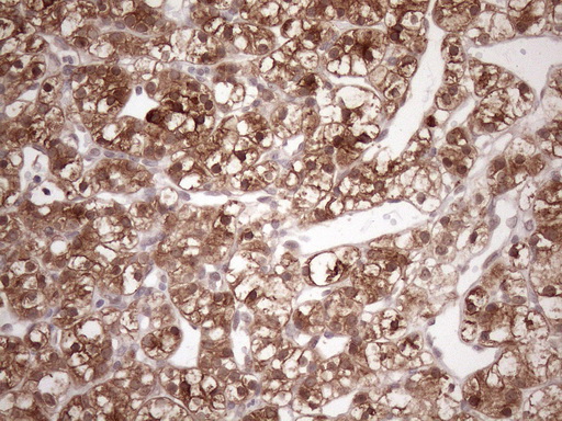 FGF13 Antibody - Immunohistochemical staining of paraffin-embedded Carcinoma of Human kidney tissue using anti-FGF13 mouse monoclonal antibody. (Heat-induced epitope retrieval by 1mM EDTA in 10mM Tris buffer. (pH8.5) at 120 oC for 3 min. (1:150)