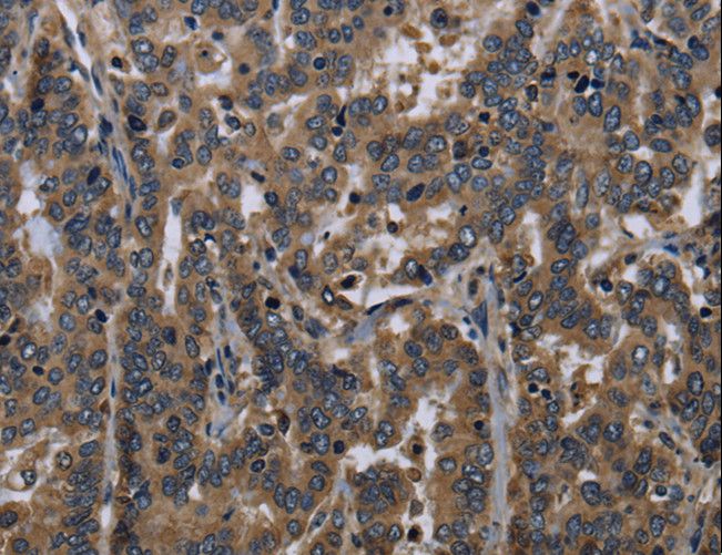 FGF18 Antibody - Immunohistochemistry of paraffin-embedded Human liver cancer using FGF18 Polyclonal Antibody at dilution of 1:40.