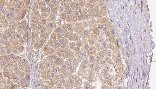 FGF19 Antibody - 1:100 staining human Melanoma tissue by IHC-P. The sample was formaldehyde fixed and a heat mediated antigen retrieval step in citrate buffer was performed. The sample was then blocked and incubated with the antibody for 1.5 hours at 22°C. An HRP conjugated goat anti-rabbit antibody was used as the secondary.