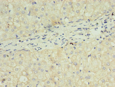 FGF2 / Basic FGF Antibody - Immunohistochemistry of paraffin-embedded human liver cancer using FGF2 Antibody at dilution of 1:100