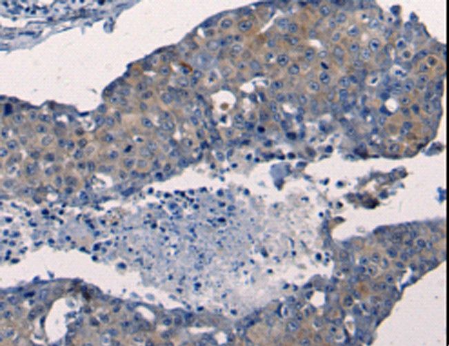 FGF2 / Basic FGF Antibody - Immunohistochemistry of paraffin-embedded Human breast cancer using FGF2 Polyclonal Antibody at dilution of 1:50.