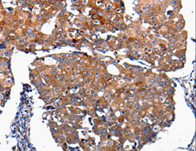 FGF2 / Basic FGF Antibody - Immunohistochemistry of paraffin-embedded Human breast cancer using FGF2 Polyclonal Antibody at dilution of 1:100.