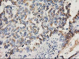 FGF21 Antibody - IHC of paraffin-embedded Carcinoma of Human lung tissue using anti-FGF21 mouse monoclonal antibody.