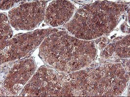 FGF21 Antibody - IHC of paraffin-embedded Carcinoma of Human liver tissue using anti-FGF21 mouse monoclonal antibody.