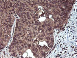 FGF21 Antibody - IHC of paraffin-embedded Carcinoma of Human lung tissue using anti-FGF21 mouse monoclonal antibody.