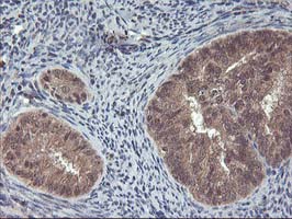 FGF21 Antibody - IHC of paraffin-embedded Adenocarcinoma of Human endometrium tissue using anti-FGF21 mouse monoclonal antibody.