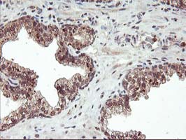 FGF21 Antibody - IHC of paraffin-embedded Carcinoma of Human prostate tissue using anti-FGF21 mouse monoclonal antibody.