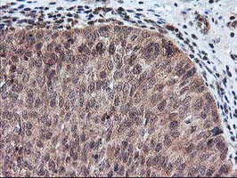 FGF21 Antibody - IHC of paraffin-embedded Carcinoma of Human bladder tissue using anti-FGF21 mouse monoclonal antibody.