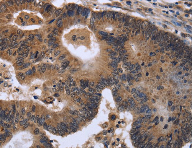 FGF21 Antibody - Immunohistochemistry of paraffin-embedded Human colon cancer using FGF21 Polyclonal Antibody at dilution of 1:40.