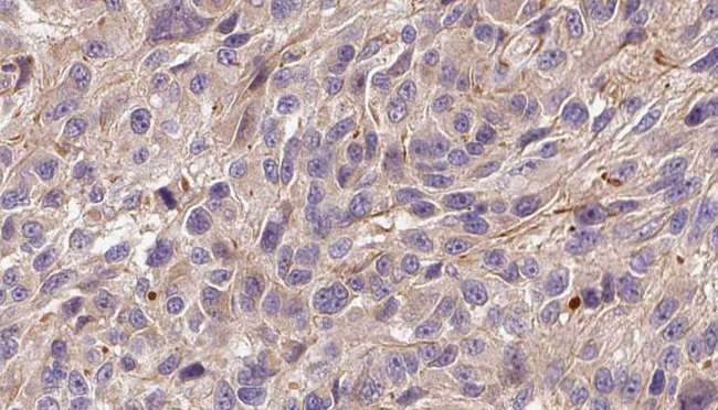 FGF22 Antibody - 1:100 staining human Melanoma tissue by IHC-P. The sample was formaldehyde fixed and a heat mediated antigen retrieval step in citrate buffer was performed. The sample was then blocked and incubated with the antibody for 1.5 hours at 22°C. An HRP conjugated goat anti-rabbit antibody was used as the secondary.