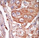 FGF4 Antibody - Formalin-fixed and paraffin-embedded human cancer tissue reacted with the primary antibody, which was peroxidase-conjugated to the secondary antibody, followed by DAB staining. This data demonstrates the use of this antibody for immunohistochemistry; clinical relevance has not been evaluated. BC = breast carcinoma; HC = hepatocarcinoma.