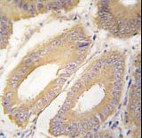 FGF4 Antibody - Formalin-fixed and paraffin-embedded human colon carcinoma tissue reacted with FGF4 Antibody , which was peroxidase-conjugated to the secondary antibody, followed by DAB staining. This data demonstrates the use of this antibody for immunohistochemistry; clinical relevance has not been evaluated.