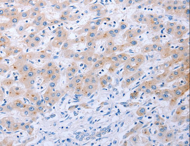 FGF4 Antibody - Immunohistochemistry of paraffin-embedded Human thyroid cancer using FGF4 Polyclonal Antibody at dilution of 1:40.