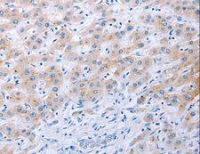 FGF4 Antibody - Immunohistochemistry of paraffin-embedded Human thyroid cancer using FGF4 Polyclonal Antibody at dilution of 1:40.