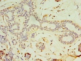 FGF6 Antibody - Immunohistochemistry of paraffin-embedded human breast cancer using antibody at 1:100 dilution.