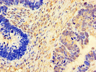 FGF8 Antibody - Immunohistochemistry of paraffin-embedded human ovarian cancer using FGF8 Antibody at dilution of 1:100