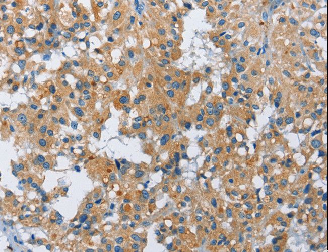 FGF9 Antibody - Immunohistochemistry of paraffin-embedded Human thyroid cancer using FGF9 Polyclonal Antibody at dilution of 1:40.