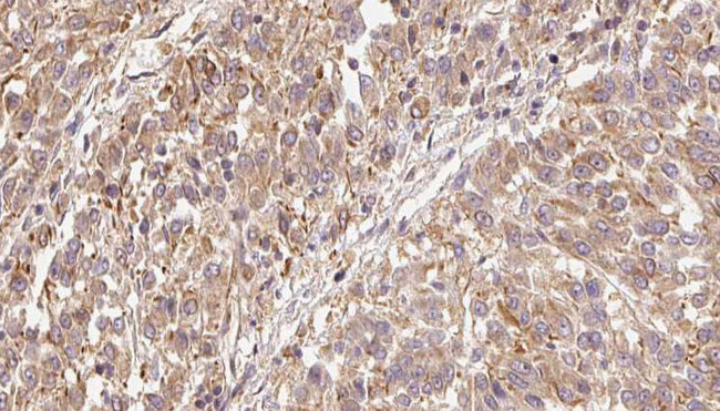 FGF9 Antibody - 1:100 staining human Melanoma tissue by IHC-P. The sample was formaldehyde fixed and a heat mediated antigen retrieval step in citrate buffer was performed. The sample was then blocked and incubated with the antibody for 1.5 hours at 22°C. An HRP conjugated goat anti-rabbit antibody was used as the secondary.
