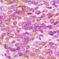 FGFR1 / FGF Receptor 1 Antibody - Immunohistochemical analysis of FGFR1 staining in human breast cancer formalin fixed paraffin embedded tissue section. The section was pre-treated using heat mediated antigen retrieval with sodium citrate buffer (pH 6.0). The section was then incubated with the antibody at room temperature and detected using an HRP conjugated compact polymer system. DAB was used as the chromogen. The section was then counterstained with hematoxylin and mounted with DPX.