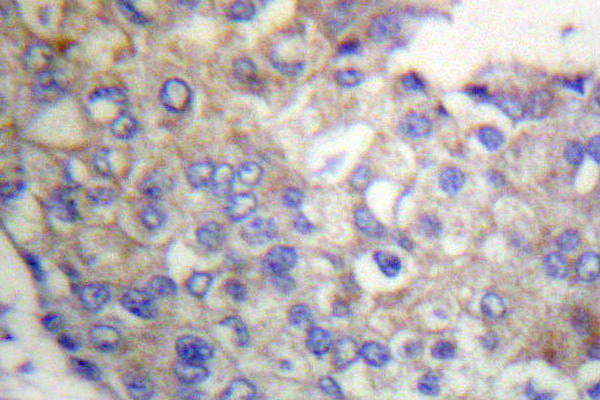 FGFR1 / FGF Receptor 1 Antibody - IHC of Flg (L760) pAb in paraffin-embedded human breast carcinoma tissue.