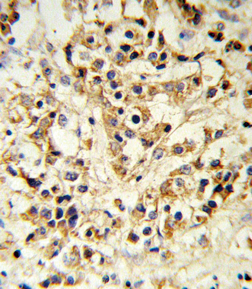 FGFR1 / FGF Receptor 1 Antibody - FGFR1 Antibody IHC of formalin-fixed and paraffin-embedded human breast carcinoma followed by peroxidase-conjugated secondary antibody and DAB staining.
