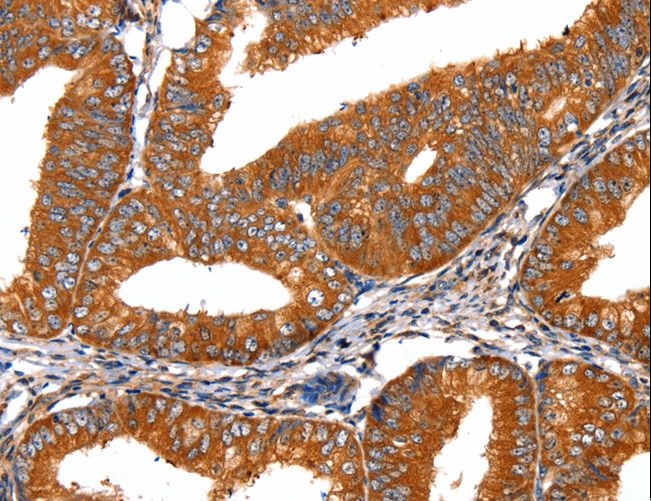 FGFR1 / FGF Receptor 1 Antibody - Immunohistochemistry of paraffin-embedded Human liver cancer using FGFR1 Polyclonal Antibody at dilution of 1:60.