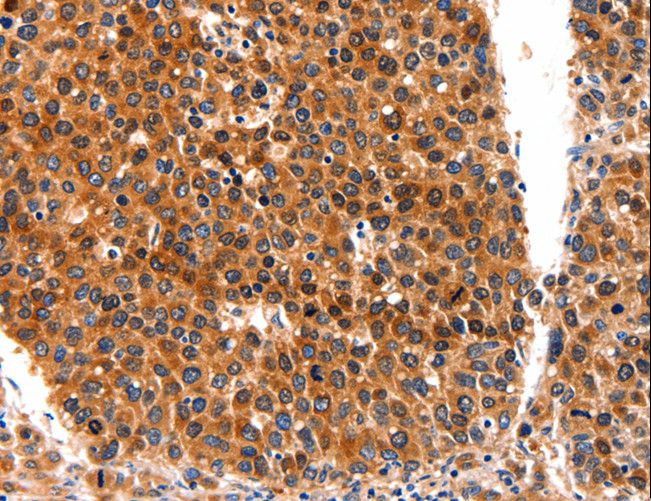 FGFR1 / FGF Receptor 1 Antibody - Immunohistochemistry of paraffin-embedded Human liver cancer using FGFR1 Polyclonal Antibody at dilution of 1:60.
