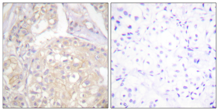 FGFR1 / FGF Receptor 1 Antibody - Immunohistochemistry analysis of paraffin-embedded human breast carcinoma, using FGFR1 (Phospho-Tyr766) Antibody. The picture on the right is blocked with the phospho peptide.