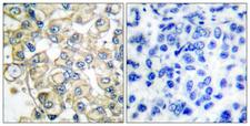 FGFR1OP / FOP Antibody - Immunohistochemistry analysis of paraffin-embedded human breast carcinoma tissue, using FGFR1 Oncogene Partner Antibody. The picture on the right is blocked with the synthesized peptide.