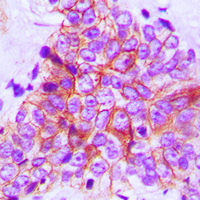 FGFR1OP / FOP Antibody - Immunohistochemical analysis of FOP staining in human breast cancer formalin fixed paraffin embedded tissue section. The section was pre-treated using heat mediated antigen retrieval with sodium citrate buffer (pH 6.0). The section was then incubated with the antibody at room temperature and detected using an HRP conjugated compact polymer system. DAB was used as the chromogen. The section was then counterstained with hematoxylin and mounted with DPX.