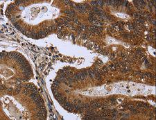 FGFR1OP / FOP Antibody - Immunohistochemistry of paraffin-embedded Human cervical cancer using FGFR1OP Polyclonal Antibody at dilution of 1:50.