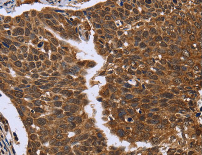 FGFR1OP / FOP Antibody - Immunohistochemistry of paraffin-embedded Human cervical cancer using FGFR1OP Polyclonal Antibody at dilution of 1:50.