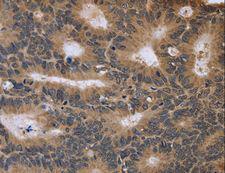 FGFR1OP2 Antibody - Immunohistochemistry of paraffin-embedded Human colon cancer using FGFR1OP2 Polyclonal Antibody at dilution of 1:40.