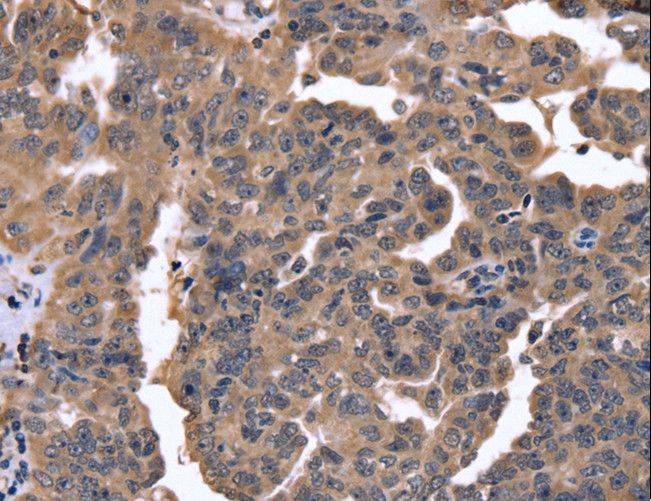 FGFR1OP2 Antibody - Immunohistochemistry of paraffin-embedded Human ovarian cancer using FGFR1OP2 Polyclonal Antibody at dilution of 1:40.