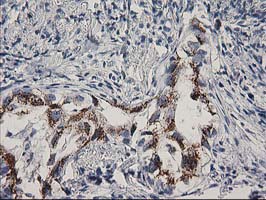 FGFR2 / FGF Receptor 2 Antibody - IHC of paraffin-embedded Carcinoma of Human lung tissue using anti-FGFR2 mouse monoclonal antibody. (Heat-induced epitope retrieval by 10mM citric buffer, pH6.0, 100C for 10min).