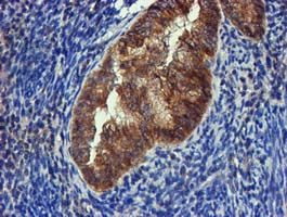 FGFR2 / FGF Receptor 2 Antibody - IHC of paraffin-embedded Adenocarcinoma of Human endometrium tissue using anti-FGFR2 mouse monoclonal antibody.