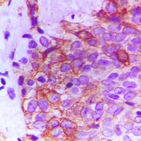 FGFR2 / FGF Receptor 2 Antibody - Immunohistochemical analysis of FGFR2 staining in human breast cancer formalin fixed paraffin embedded tissue section. The section was pre-treated using heat mediated antigen retrieval with sodium citrate buffer (pH 6.0). The section was then incubated with the antibody at room temperature and detected using an HRP conjugated compact polymer system. DAB was used as the chromogen. The section was then counterstained with hematoxylin and mounted with DPX.