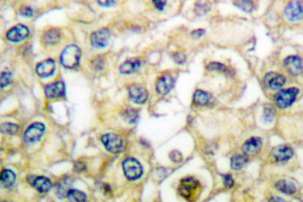 FGFR2 / FGF Receptor 2 Antibody - IHC of FGFR2 (V501) pAb in paraffin-embedded human breast carcinoma tissue.