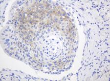 FGFR3 Antibody - IHC of paraffin-embedded Carcinoma of Human lung tissue using anti-FGFR3 mouse monoclonal antibody. (Heat-induced epitope retrieval by 10mM citric buffer, pH6.0, 120°C for 3min).