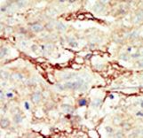 FGFR3 Antibody - Formalin-fixed and paraffin-embedded human cancer tissue reacted with the primary antibody, which was peroxidase-conjugated to the secondary antibody, followed by DAB staining. This data demonstrates the use of this antibody for immunohistochemistry; clinical relevance has not been evaluated. BC = breast carcinoma; HC = hepatocarcinoma.