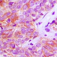 FGFR3 Antibody - Immunohistochemical analysis of FGFR3 staining in human breast cancer formalin fixed paraffin embedded tissue section. The section was pre-treated using heat mediated antigen retrieval with sodium citrate buffer (pH 6.0). The section was then incubated with the antibody at room temperature and detected using an HRP conjugated compact polymer system. DAB was used as the chromogen. The section was then counterstained with hematoxylin and mounted with DPX.