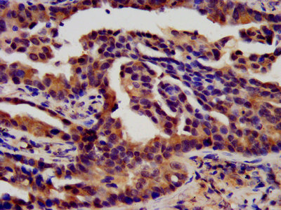 FGFR3 Antibody - IHC image of FGFR3 Antibody diluted at 1:450 and staining in paraffin-embedded human lung cancer performed on a Leica BondTM system. After dewaxing and hydration, antigen retrieval was mediated by high pressure in a citrate buffer (pH 6.0). Section was blocked with 10% normal goat serum 30min at RT. Then primary antibody (1% BSA) was incubated at 4°C overnight. The primary is detected by a biotinylated secondary antibody and visualized using an HRP conjugated SP system.