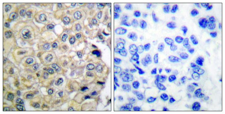 FGFR3 Antibody - Peptide - + Immunohistochemical analysis of paraffin-embedded human breast carcinoma tissue using FGFR3 antibody.