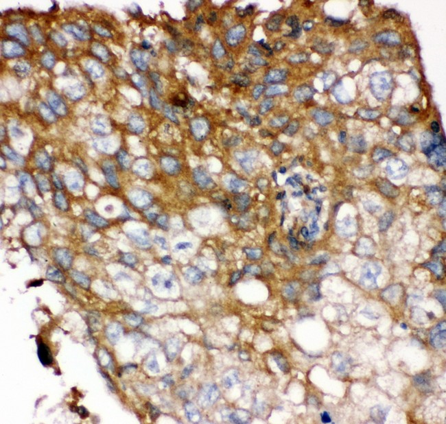 FGFR4 Antibody - FGFR4 antibody IHC-paraffin: Human Lung Cancer Tissue.