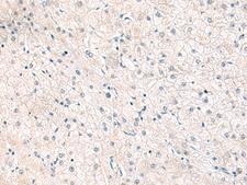 FGFR4 Antibody - Immunohistochemistry of paraffin-embedded Human liver cancer tissue  using FGFR4 Polyclonal Antibody at dilution of 1:25(×200)