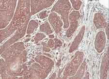 FGFRL1 Antibody - IHC of paraffin-embedded Oral CA Cal27 xenograft using FGFRL1 antibody at 1:100 dilution.