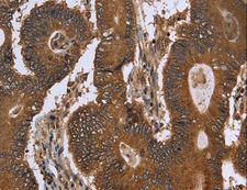 FGFRL1 Antibody - Immunohistochemistry of paraffin-embedded Human colon cancer using FGFRL1 Polyclonal Antibody at dilution of 1:40.