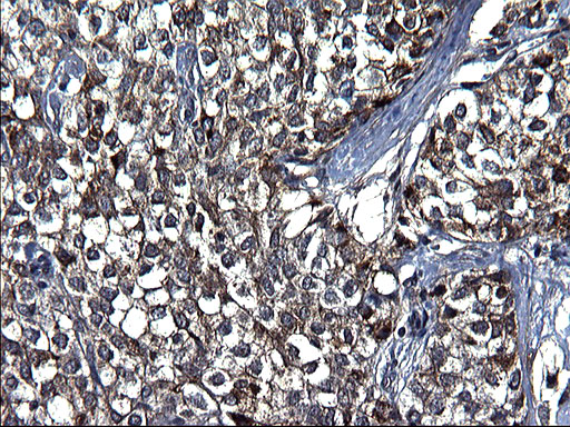 FGG / Fibrinogen Gamma Antibody - IHC of paraffin-embedded Carcinoma of Human liver tissue using anti-FGG mouse monoclonal antibody. (Heat-induced epitope retrieval by 1 mM EDTA in 10mM Tris, pH8.5, 120°C for 3min).