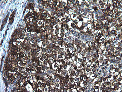 FGG / Fibrinogen Gamma Antibody - IHC of paraffin-embedded Carcinoma of Human liver tissue using anti-FGG mouse monoclonal antibody. (Heat-induced epitope retrieval by 1 mM EDTA in 10mM Tris, pH8.5, 120°C for 3min).